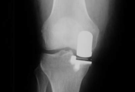 Schlittenprothese im Röntgenbild